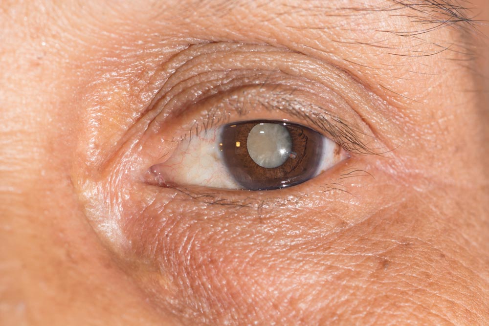 cataracts-surgery